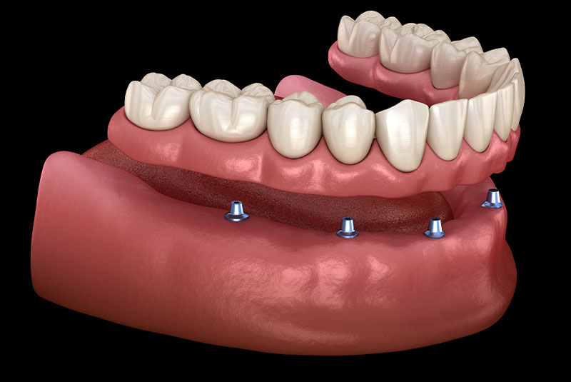 Mandibular prosthesis All on 6 system supported by implants