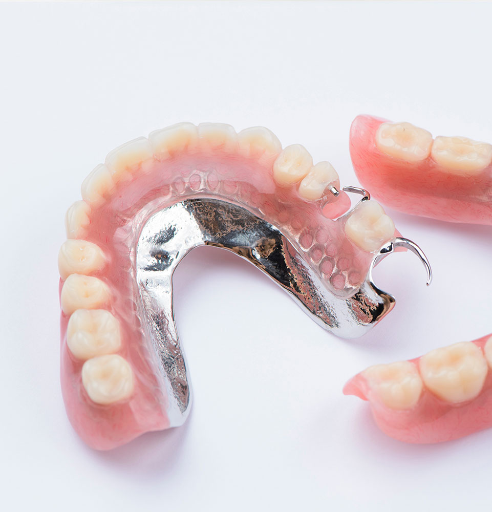 Removable metal partial denture