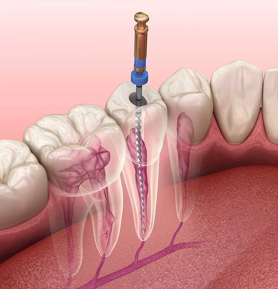 root canal illsutration