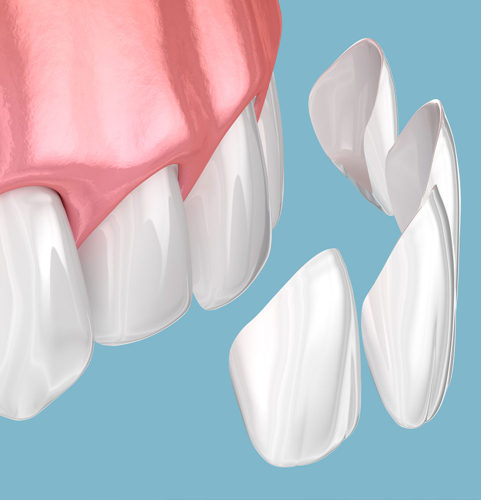 illustration veneer model
