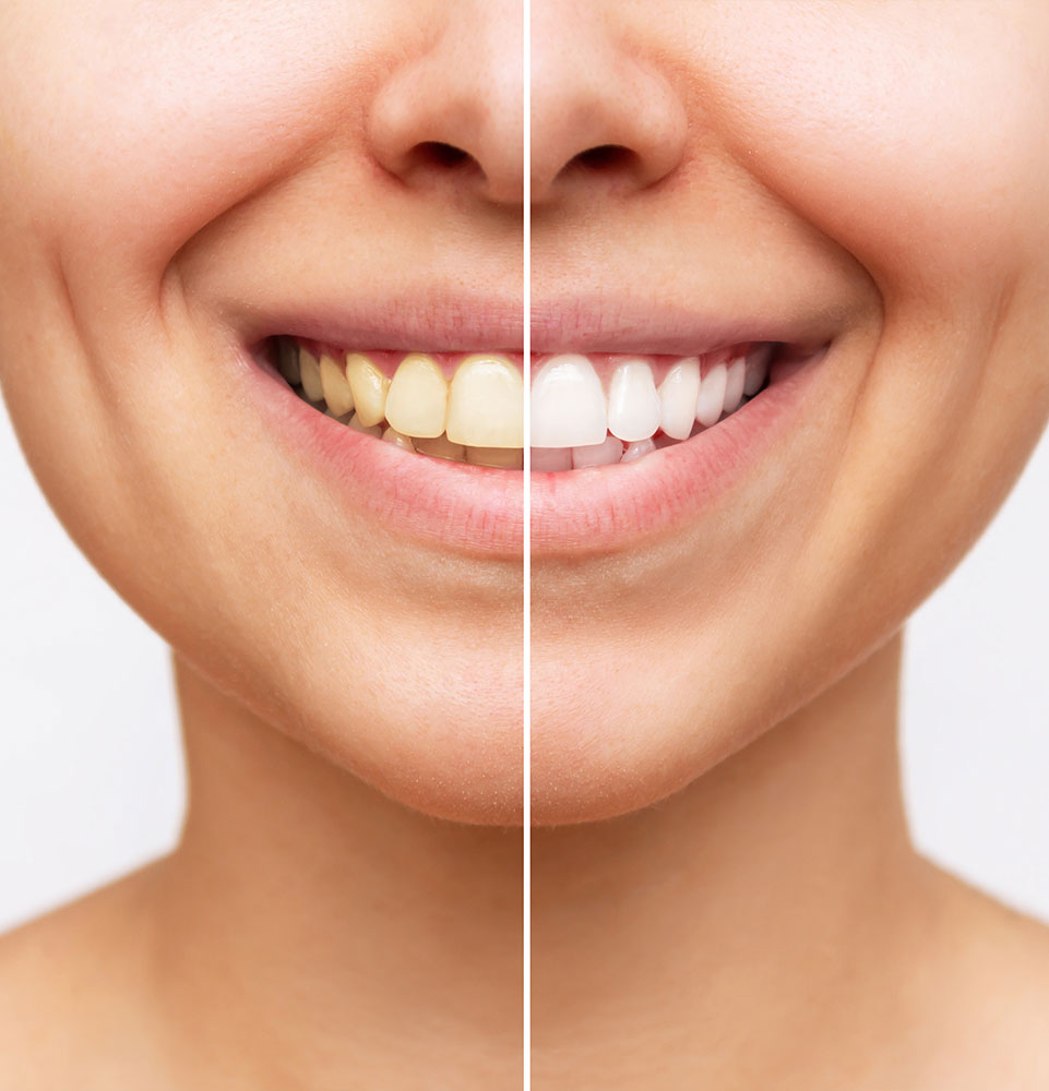 close up of whitening before and after comparison